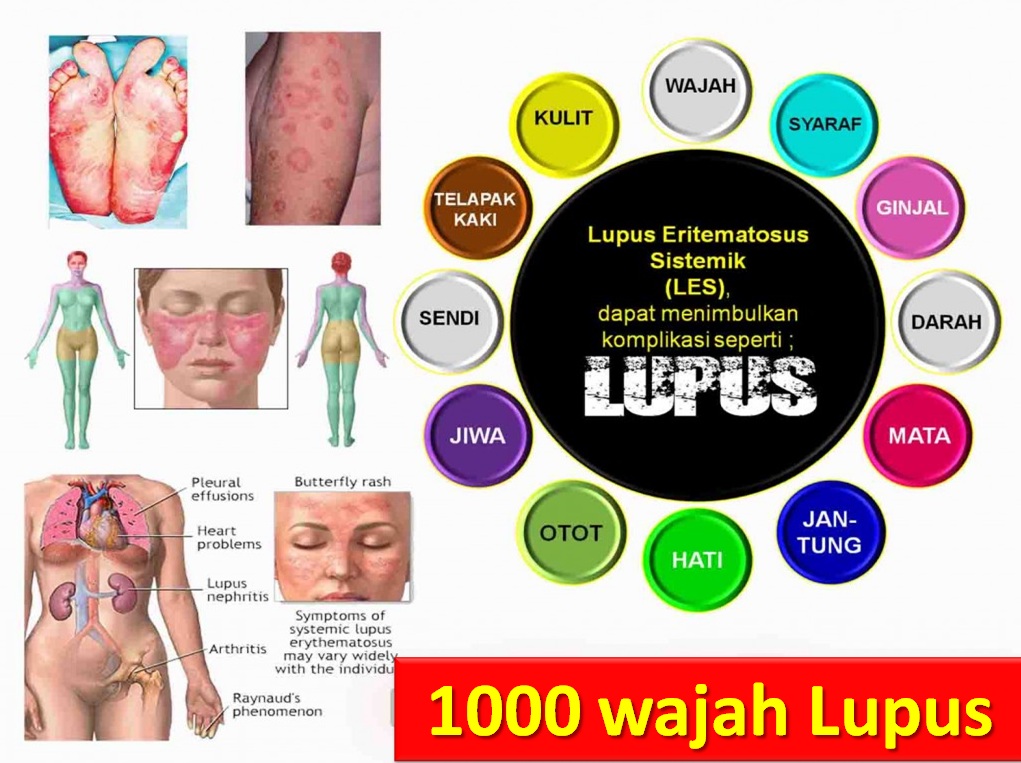 Como se puede diagnosticar el lupus
